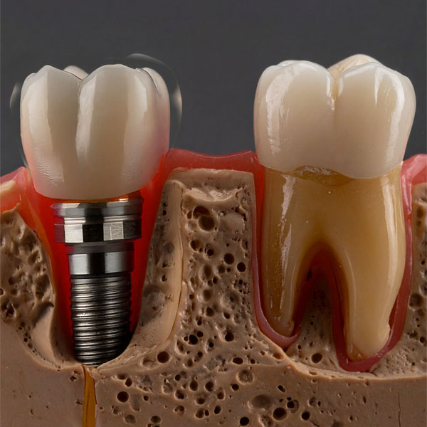 Dental Implants