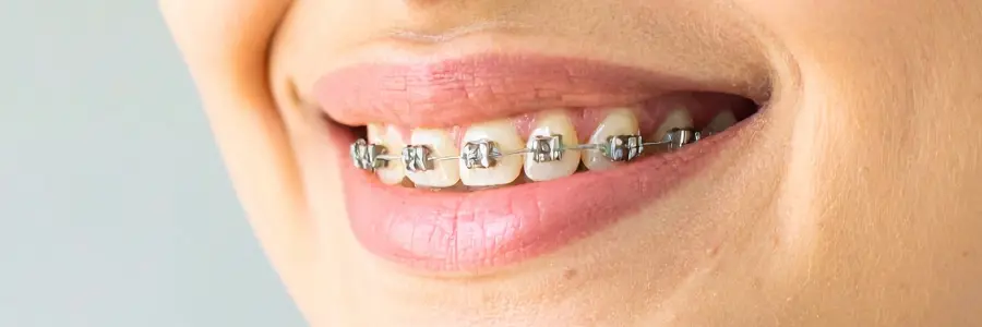 braces vs aligners