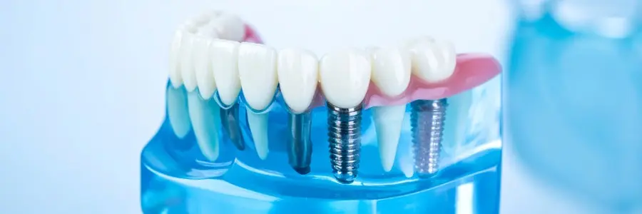 Dental Implants 