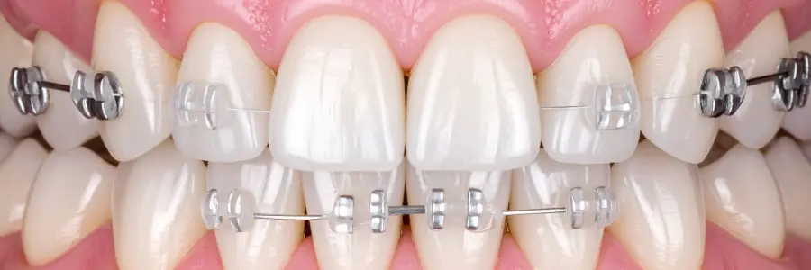 Metal and Ceramic Braces