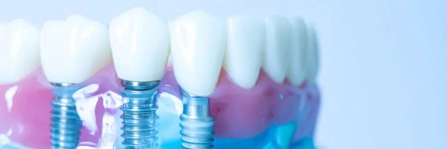 types of Dental Implants