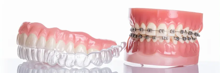 What are Braces and Clear Aligners