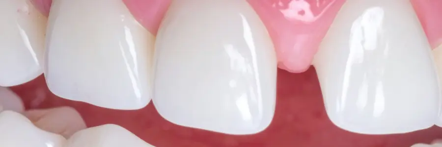 Orthodontic Treatment is needed