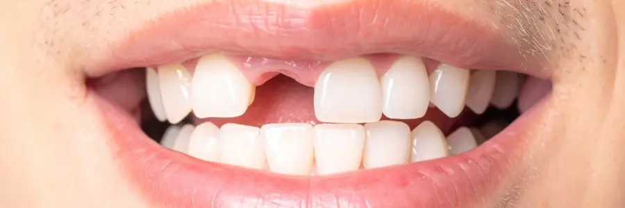 Who needs Dental Implants