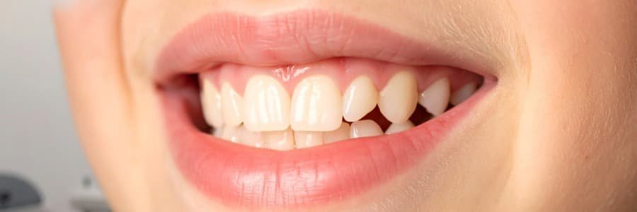 Benefits of tooth coloured fillings